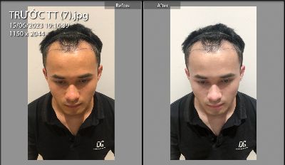 Bài tập edit các thông số cho chân dung Before và After