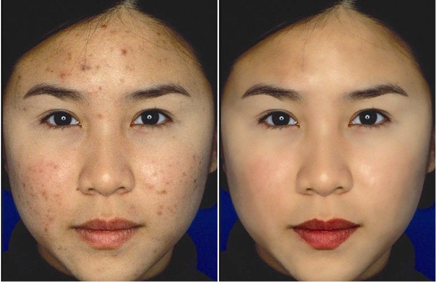 Retouch Before-After